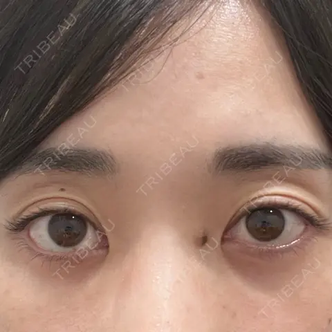 ヒアルロン酸注入（目の下） EMMO FACE CLINIC 大宮院 BEFORE