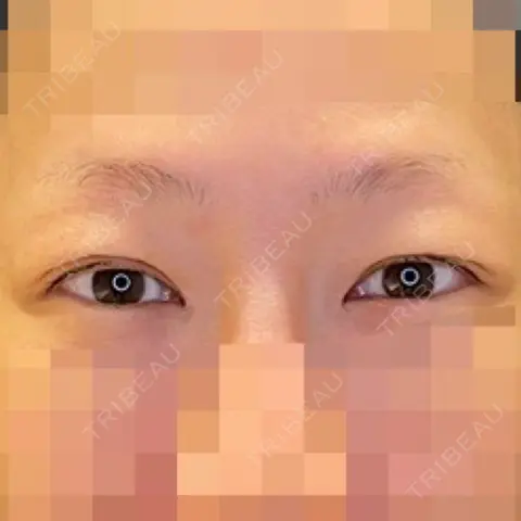 目尻切開 / タレ目形成・グラマラスライン（埋没） LOUIS CLINIC 二子玉川院【ルイクリニック】 AFTER