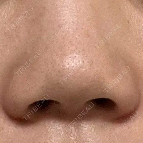 隆鼻術 / 鼻尖形成（切開） / 小鼻縮小（切開） / 軟骨移植 / 鼻尖縮小 / 真皮移植 / 鼻孔縁下降 X CLINIC 恵比寿院 AFTER
