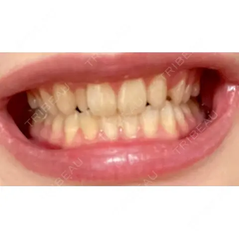 ホワイトニング LEAGRANT CLINIC 中目黒 AFTER