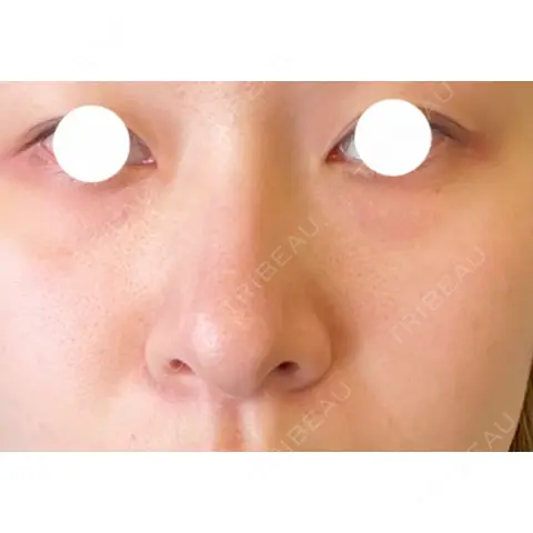 クマ治療 / PRP皮膚再生療法 / その他（口元） Pono clinic 【ポノクリ】 AFTER