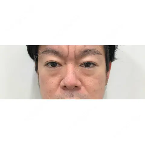 クマ治療 / PRP皮膚再生療法 Pono clinic 【ポノクリ】 AFTER