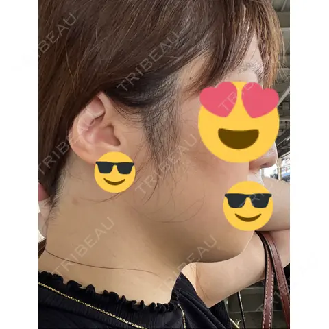 脂肪吸引（顔） 湘南美容クリニック 札幌院 AFTER