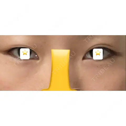 目頭切開 / 眼瞼下垂（切開） / 上まぶたの脂肪取り いちのせ形成外科・皮膚科 眼瞼＆フェイスクリニック AFTER
