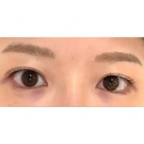 目頭切開 AI Beauty Clinic （エーアイ美容クリニック） BEFORE