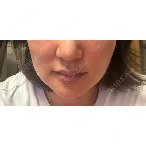 ニードルRF（ポテンツァなど） ゆう美容クリニック AFTER