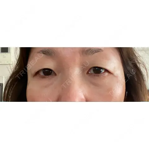 クマ治療 / PRP皮膚再生療法 Pono clinic 【ポノクリ】 AFTER