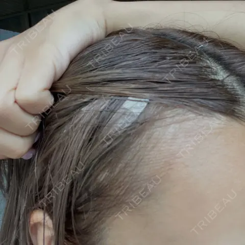 アートメイク（ヘアライン） Tokyo Tensei Clinic 新宿院 AFTER