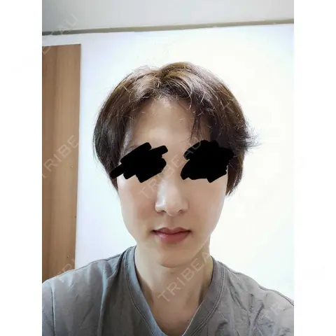 鼻修正 / 鼻尖縮小 id（アイディ）美容外科 AFTER