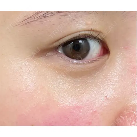 二重埋没 9BeautyClinic AFTER