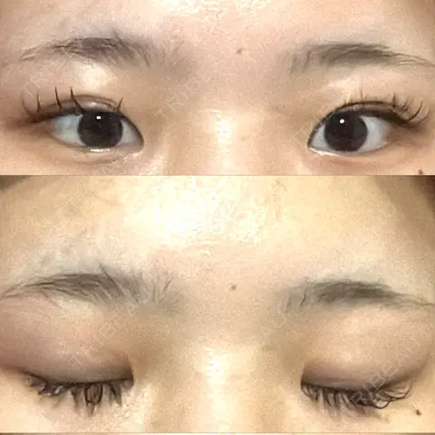 二重埋没 / 目頭切開 HAAB×DREAM BEAUTY CLINIC 大阪梅田院 AFTER