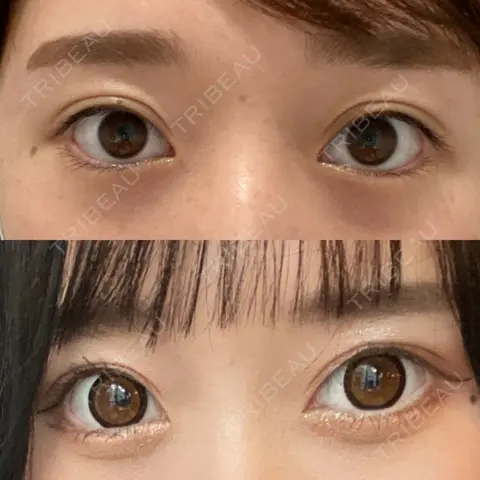二重埋没 / ヒアルロン酸注入（涙袋） Olino美容外科・美容皮膚科 AFTER