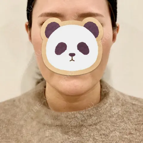 糸リフト / 脂肪吸引（顔） A CLINIC（エークリニック） 銀座院 AFTER