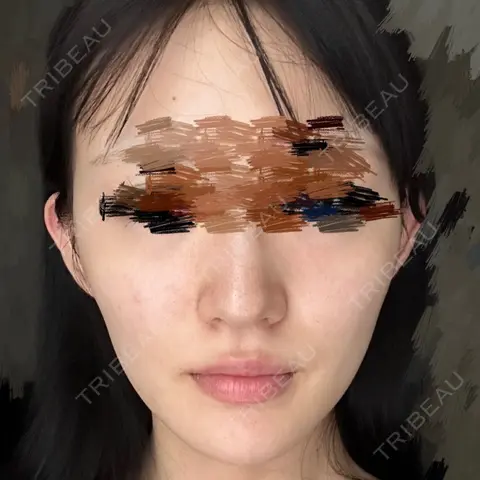 鼻尖形成（切開） / 小鼻縮小（切開） / 軟骨移植 / 鼻尖縮小 / 鼻翼基部形成（貴族手術） 銀座マイアミ美容外科 AFTER
