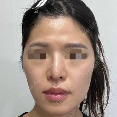 軟骨移植 / ワシ鼻修正・ハンプ切除 / プロテーゼ除去 / 鼻修正 ヒューマン美容外科 AFTER