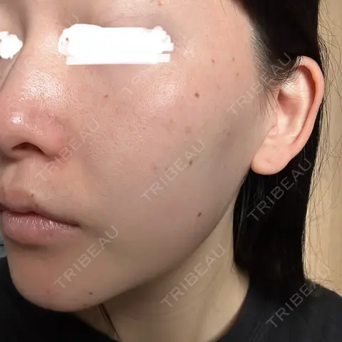 シミ取りレーザー Olino美容外科・美容皮膚科 AFTER