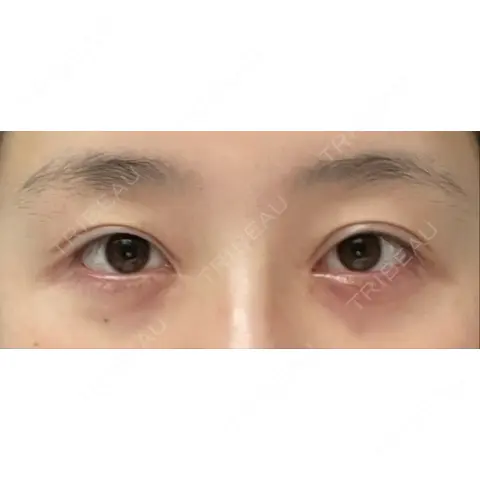 眉下切開 くさのたろうクリニック AFTER