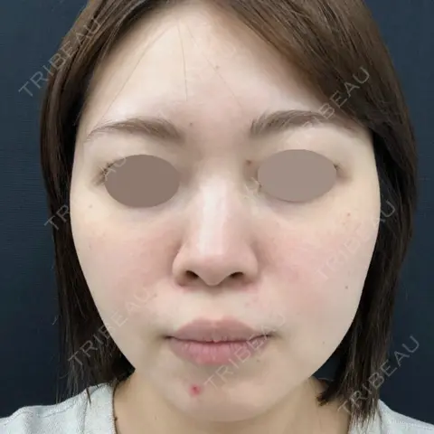 糸リフト / バッカルファット除去 / 脂肪吸引（顔） 湘南美容クリニック 京都院 AFTER