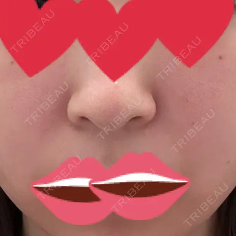 ヒアルロン酸注入（鼻翼基部） DMTC美容皮膚科 日本橋院 AFTER