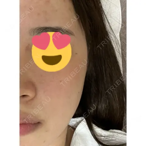 ピーリング（ニキビ・毛穴） LIFIX BEAUTY CLINIC BEFORE