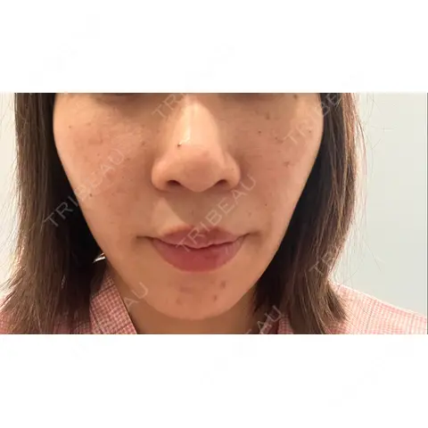 小鼻縮小（切開） / 人中短縮 / 鼻翼挙上 Otus Clinic 【オータスクリニック】 AFTER