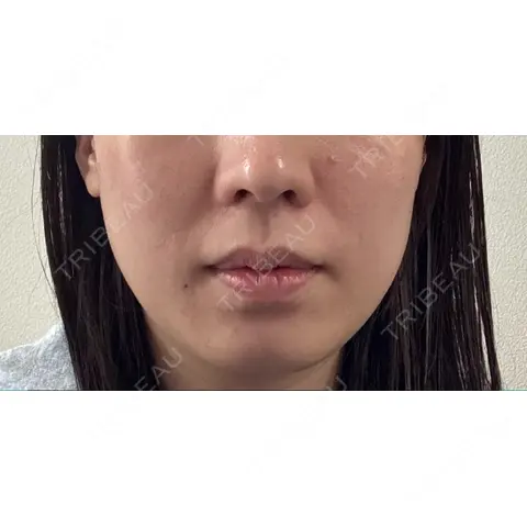 医療痩身（顔） リアルクリニック（REAL CLINIC） AFTER