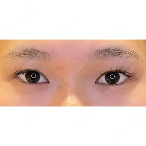 目尻切開 / タレ目形成・グラマラスライン（埋没） / 美容点滴・美容注射（美肌） LOUIS CLINIC 二子玉川院【ルイクリニック】 AFTER