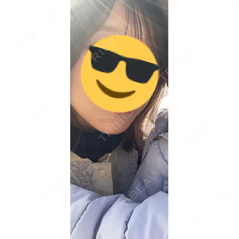 ハイフ（顔） / ハイフ（首） TCB東京中央美容外科 熊本院 AFTER