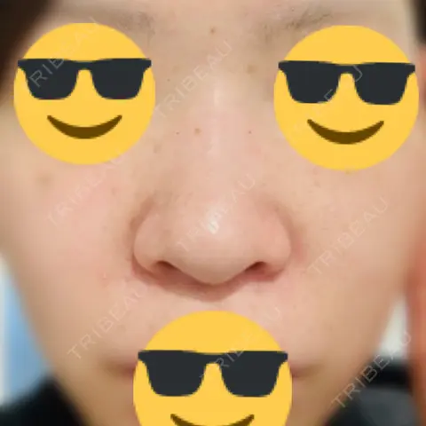 鼻尖形成（切開） / 鼻中隔延長（切開） / 小鼻縮小（切開） / 軟骨移植 / 眉間プロテーゼ 湘南美容クリニック 新潟院 AFTER