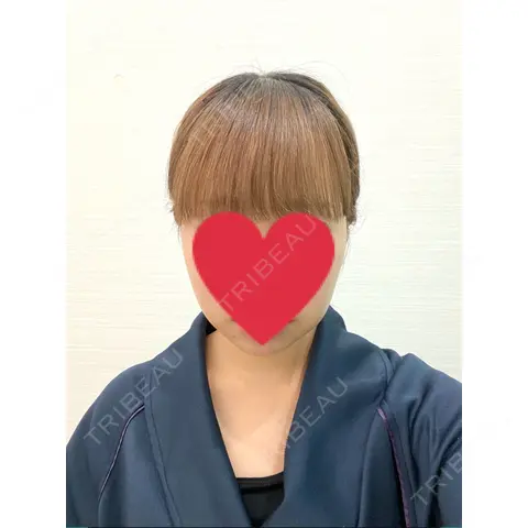 ジョールファット除去 WOM CLINIC GINZA （ワム クリニック ギンザ） BEFORE