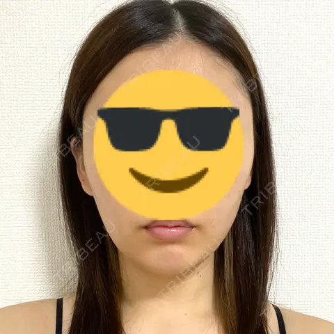 脂肪吸引（顔） WOM CLINIC GINZA （ワム クリニック ギンザ） BEFORE