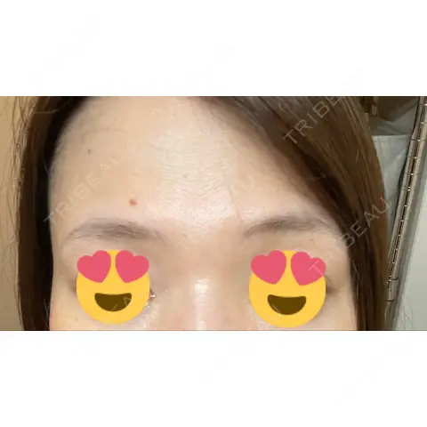 額を丸く / ヒアルロン酸注入（額） / ヒアルロン酸注入（こめかみ） TCB東京中央美容外科 京都四条院 AFTER