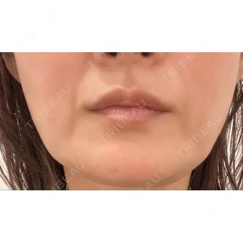 糸リフト / 脂肪吸引（顔） RIVER CLINIC（リバークリニック） AFTER