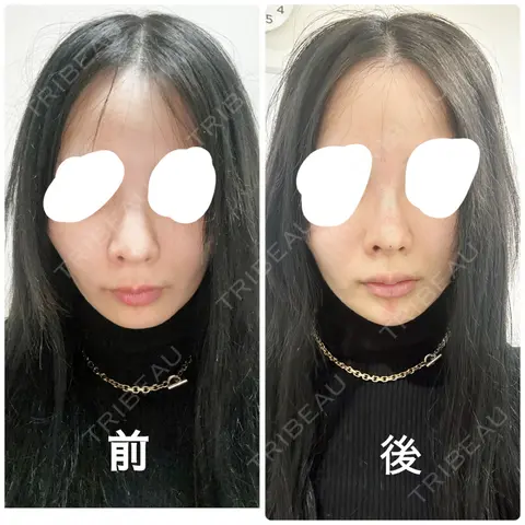 ヒアルロン酸注入（鼻） / ヒアルロン酸注入（あご） HAAB×DREAM BEAUTY CLINIC 東京本院 AFTER