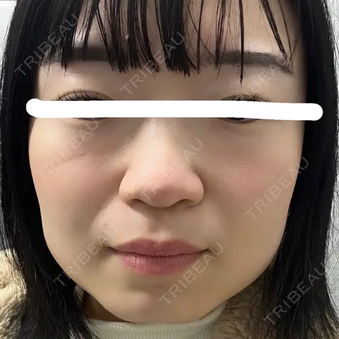 ボトックス（エラ・小顔） 湘南美容クリニック 金山院 AFTER