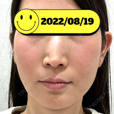 クマ治療 / 脂肪注入（肌） / 脂肪注入（目の下） EMMO FACE CLINIC 大宮院 AFTER