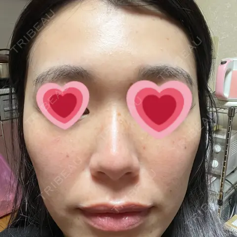 美肌レーザー なのはなクリニック AFTER