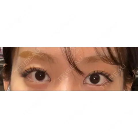 目頭切開 / 美容点滴・美容注射（疲労回復） HAAB×DREAM BEAUTY CLINIC 大阪梅田院 AFTER