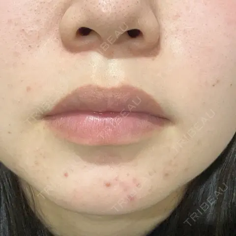 ピーリング（ニキビ・毛穴） LIFIX BEAUTY CLINIC BEFORE