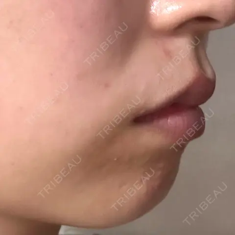 ボトックス（あご） ルラ美容クリニック 上野院 AFTER