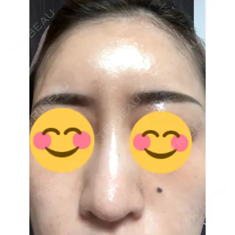 水光注射（ハリ・美肌） 東京美容外科 熊本院 AFTER