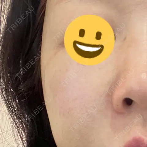 シミ取りレーザー Kobe OCEANS Clinic AFTER
