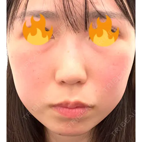 軟骨移植 / 鼻尖形成（非切開） / 鼻柱下降・鼻唇角形成（猫手術） / ヒアルロン酸注入（あご） / その他（鼻） グローバルビューティークリニック 東京院 AFTER