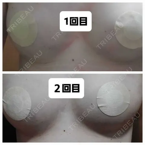 豊胸（脂肪注入） 銀座マイアミ美容外科 BEFORE