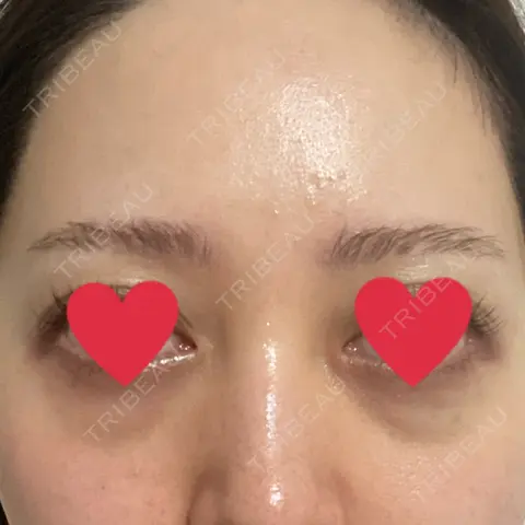 クマ治療 EMMO FACE CLINIC 大宮院 AFTER