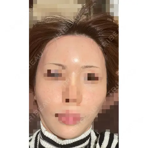 水光注射（ハリ・美肌） LIAN clinic【リアンクリニック】 AFTER