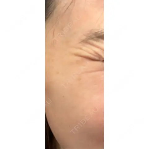 シワ取りボトックス / ボトックス（眉間） / ボトックス（目尻） / ボトックス（額） / ボトックス（ガミースマイル） ビューティースキンクリニック 池袋院 AFTER