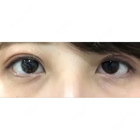 ヒアルロン酸注入（涙袋） ながしまクリニック AFTER