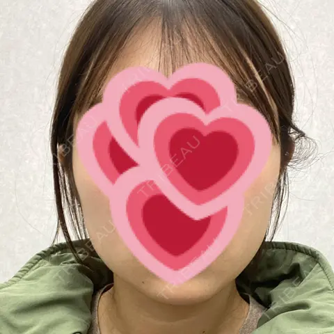 ボトックス（エラ・小顔） KARIS beauty clinic BEFORE