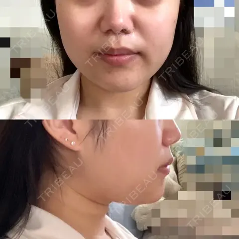 糸リフト / 脂肪吸引（顔） / ボトックス（エラ・小顔） RIVER CLINIC（リバークリニック） AFTER